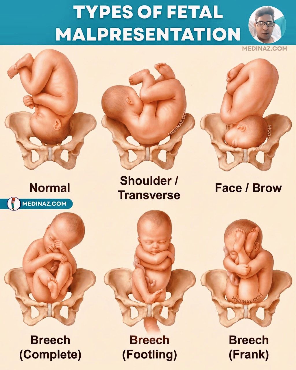 Medical - Types Of FETAL MALPRESENTATION Nice Explained!... | Facebook