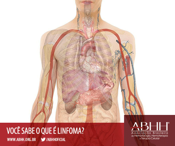 ABHH - Desconhecido da população, o linfoma deve ter diagnóstico ...