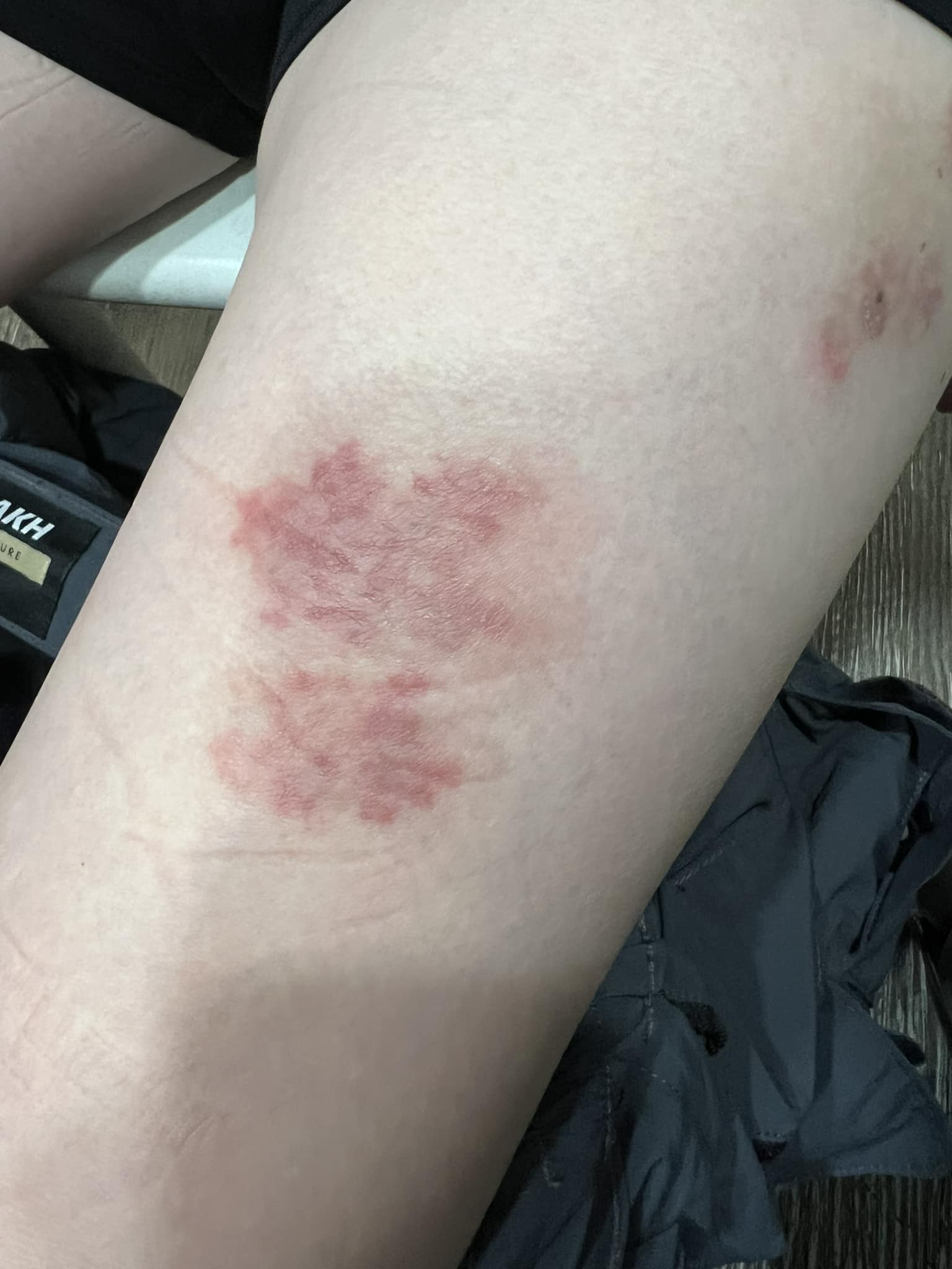 皮膚專科醫師 黃翔 - 這個看起來很像濕疹的病灶 病人在其他診所擦了很久的藥還沒好 還有點變大... | Facebook