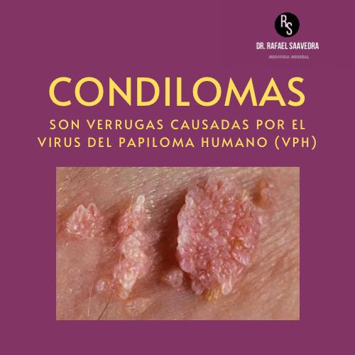 Doctor Tampico - Los condilomas, también conocidos como...