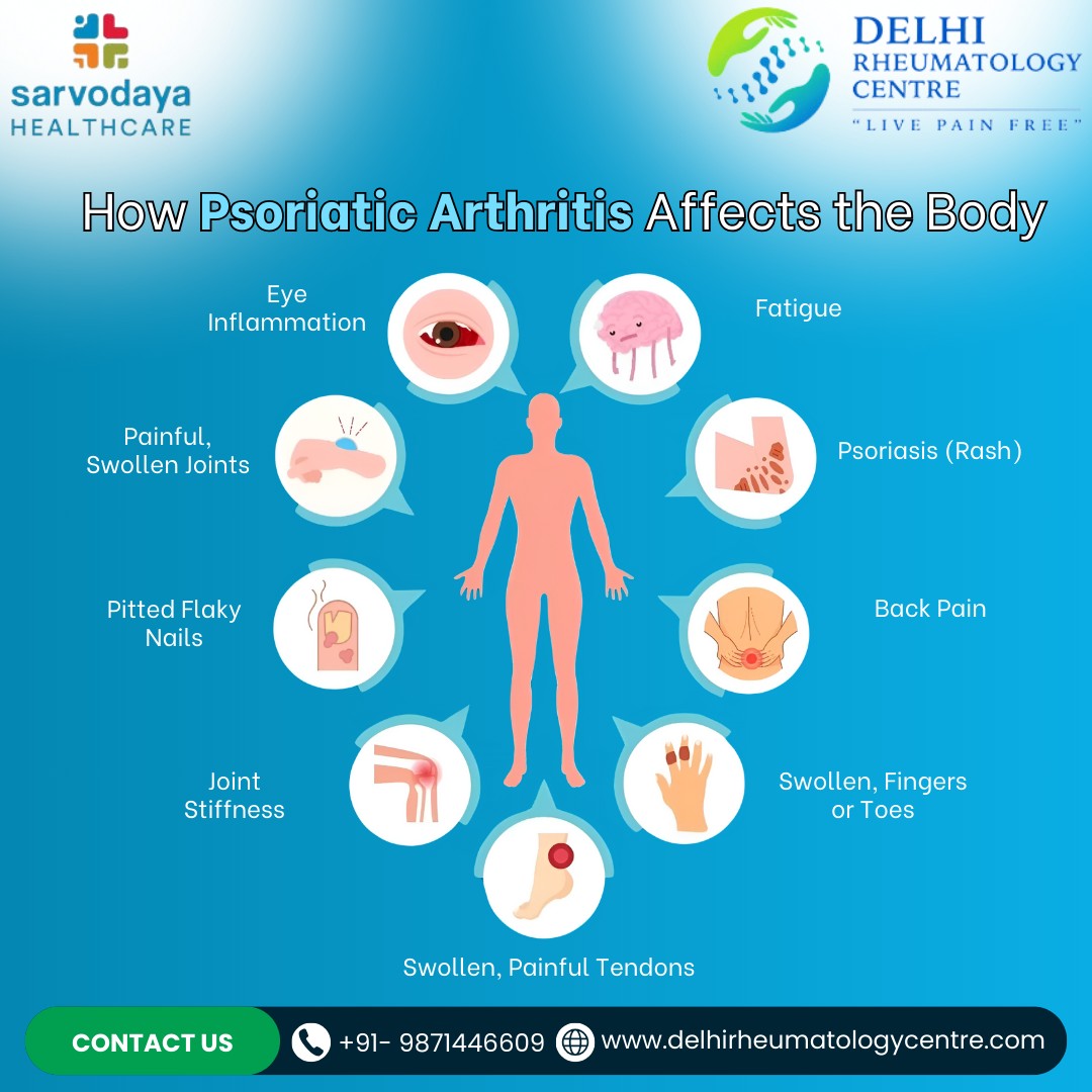 Understanding Psoriatic Arthritis: How It Affects the Body Psoriatic Arthritis is more than just joint pain. Here's how it impacts your body. Awareness is key! If you experience these symptoms, consult a