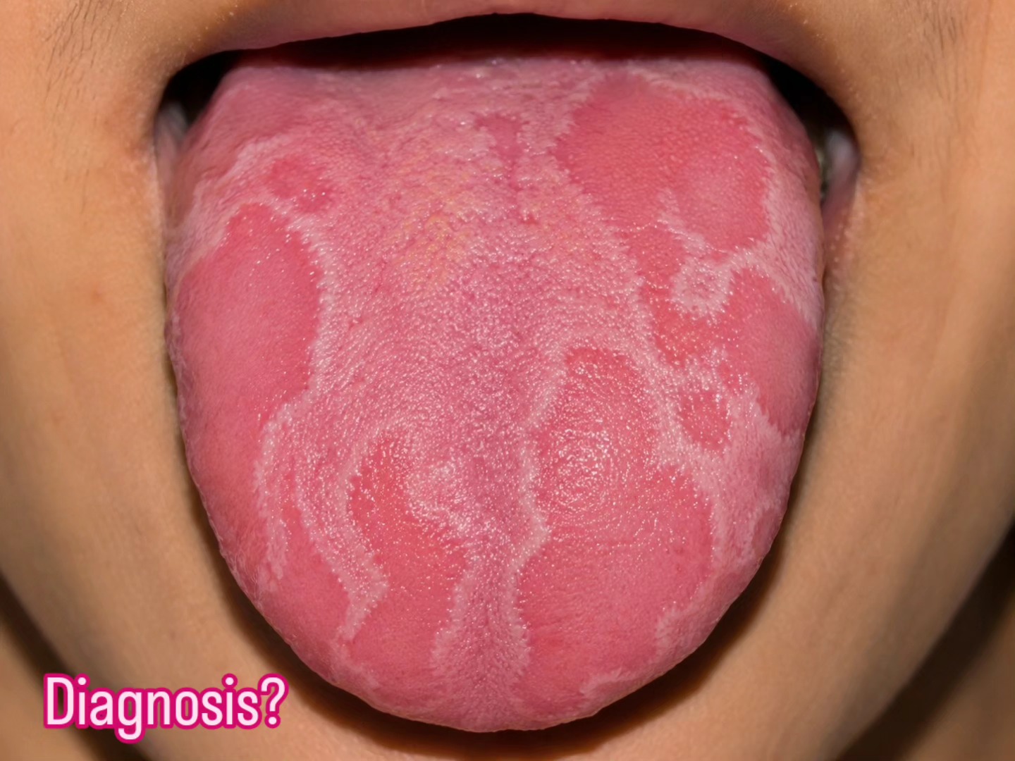 melanotic macules on tongue macule Pigmented the of a 12-year-old girl Oral Melanotic Macule: a small – what is melanotic macules of
