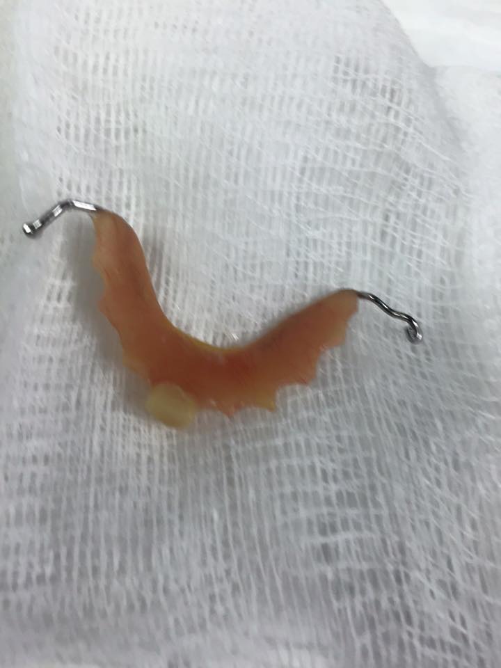 Extracción de... - Baja Endoscopic - Endoscopic Weight Loss