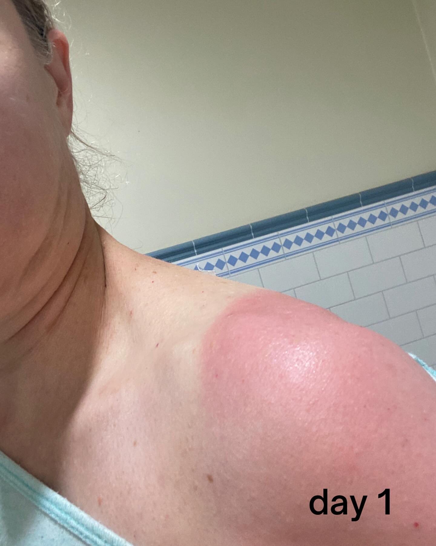 Does anyone have a sensation of sunburnt skin on Reta?