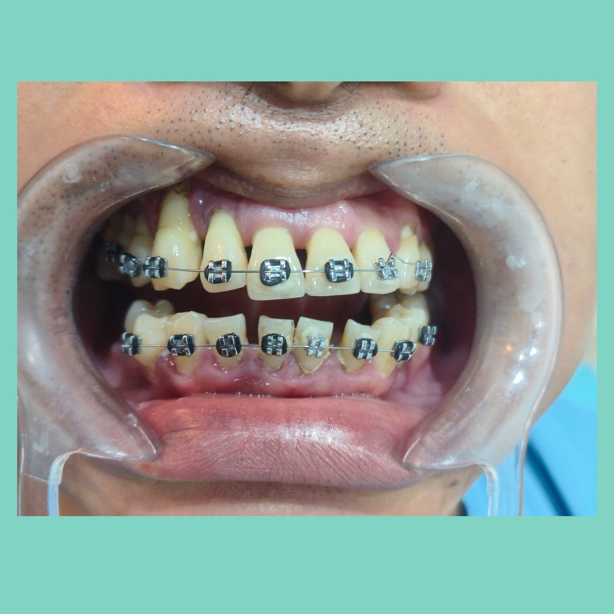 Tooth - DIY Braces: Effects and Disadvantages Thinking about trying DIY ...