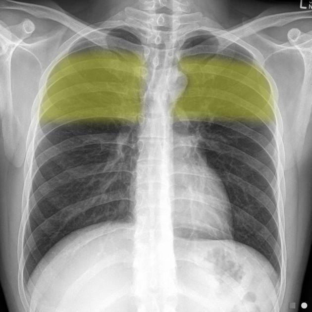 Chest Radiograph Zones: • apical zone - above the clavicles • upper ...