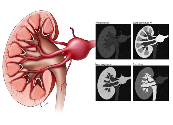 Renal Artery Aneurysm Illustration showing the enhancement of a renal ...