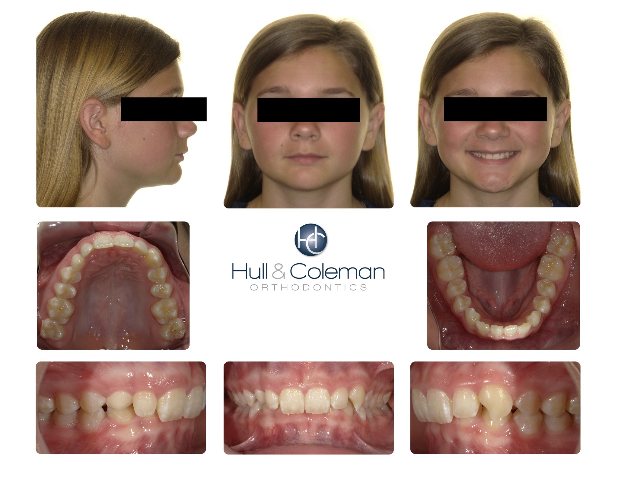 This young lady had an impacted... - Isoglide Eruption Spring