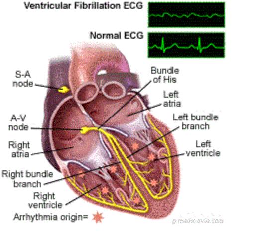 MedicTests.com - Ventricular Fibrillation (V-Fib) With V-Fib there are ...