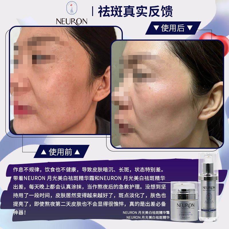Kate - 🤪黄褐斑真的把我折腾的够呛!脸上时不时的起皮发痒皮肤也变得粗糙暗沉 🤪整个人看起来显老还没精神，还好用了闺蜜给我推荐的美白祛斑 ...
