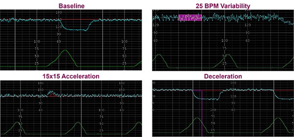 OBIX - FHR Interpretation Made Easier for Nurses Interpreting fetal ...