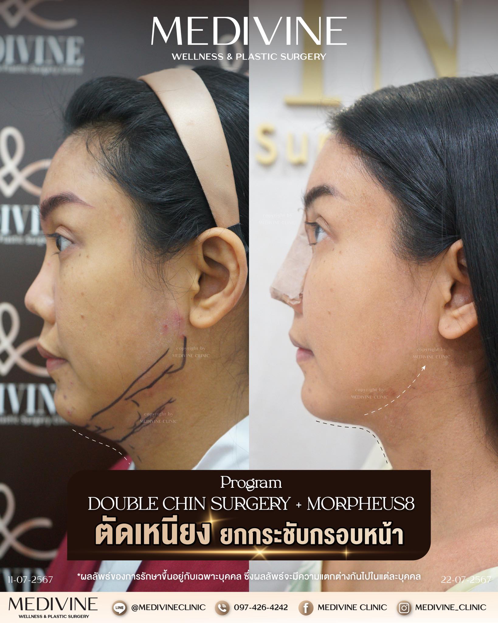 โปรแกรม #ตัดเหนียง (Double Chin Surgery Program) ใครมีเหนียงเยอะ เหนียง ...