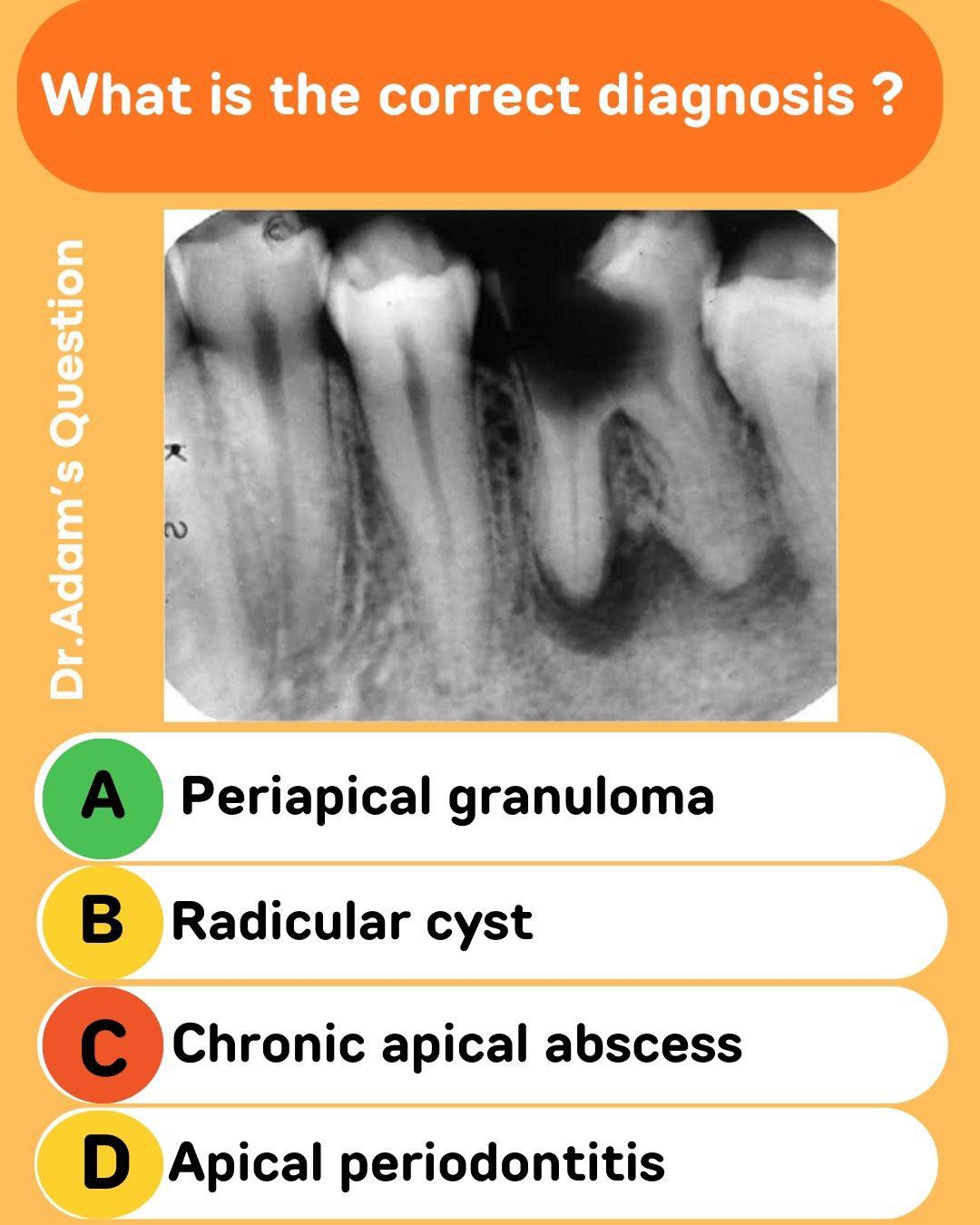 A well circumscribed radiolucency is seen around the apex of a non ...