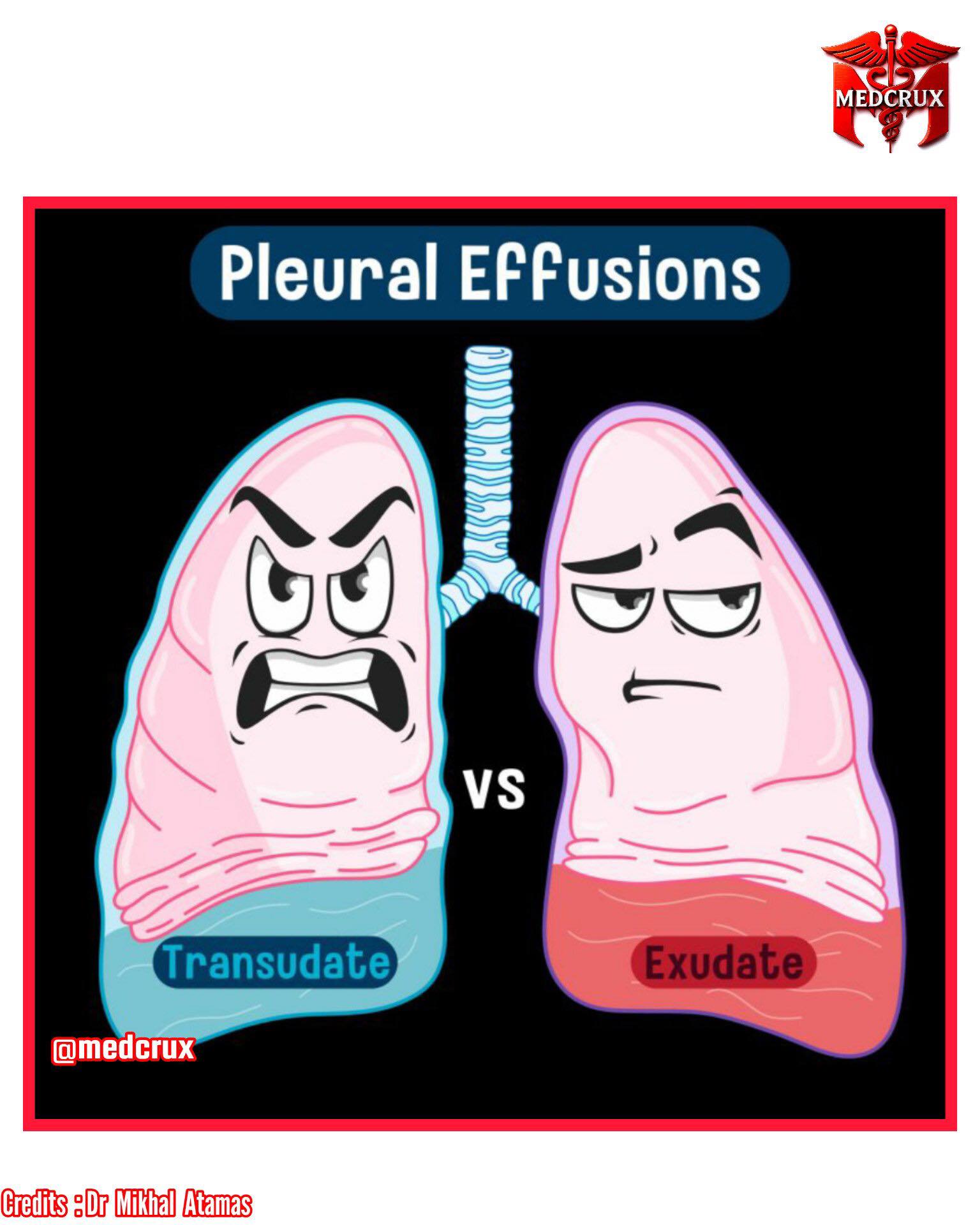 Vince - 🛑 Transudate vs Exudate (Effusion) 📌 Transudate: 🔷️ Low protein ...