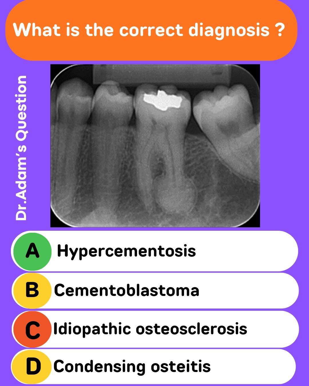 A radiopaque mass fused to the root of a vital molar with a surrounding ...