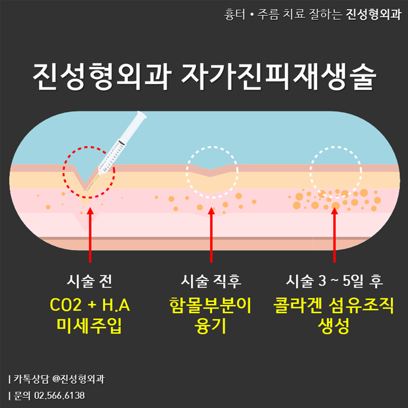진성형외과 자가진피재생술 - 여드름패인흉터, 세이 굿바이! 거울을 볼 때 마다, 사진을 찍을 때 마다,... | Facebook