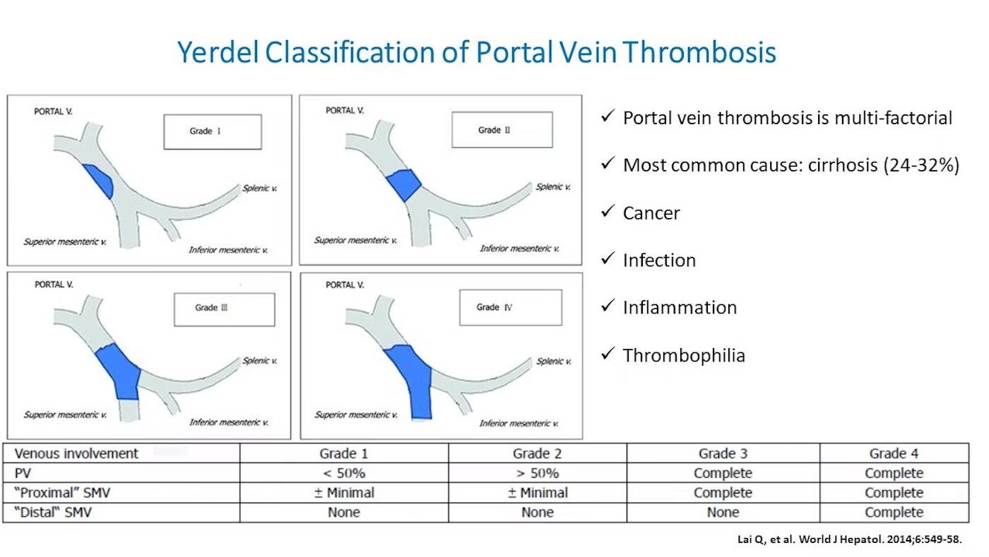 EndoCollab - Yerdel classification of portal vein thrombosis | Facebook