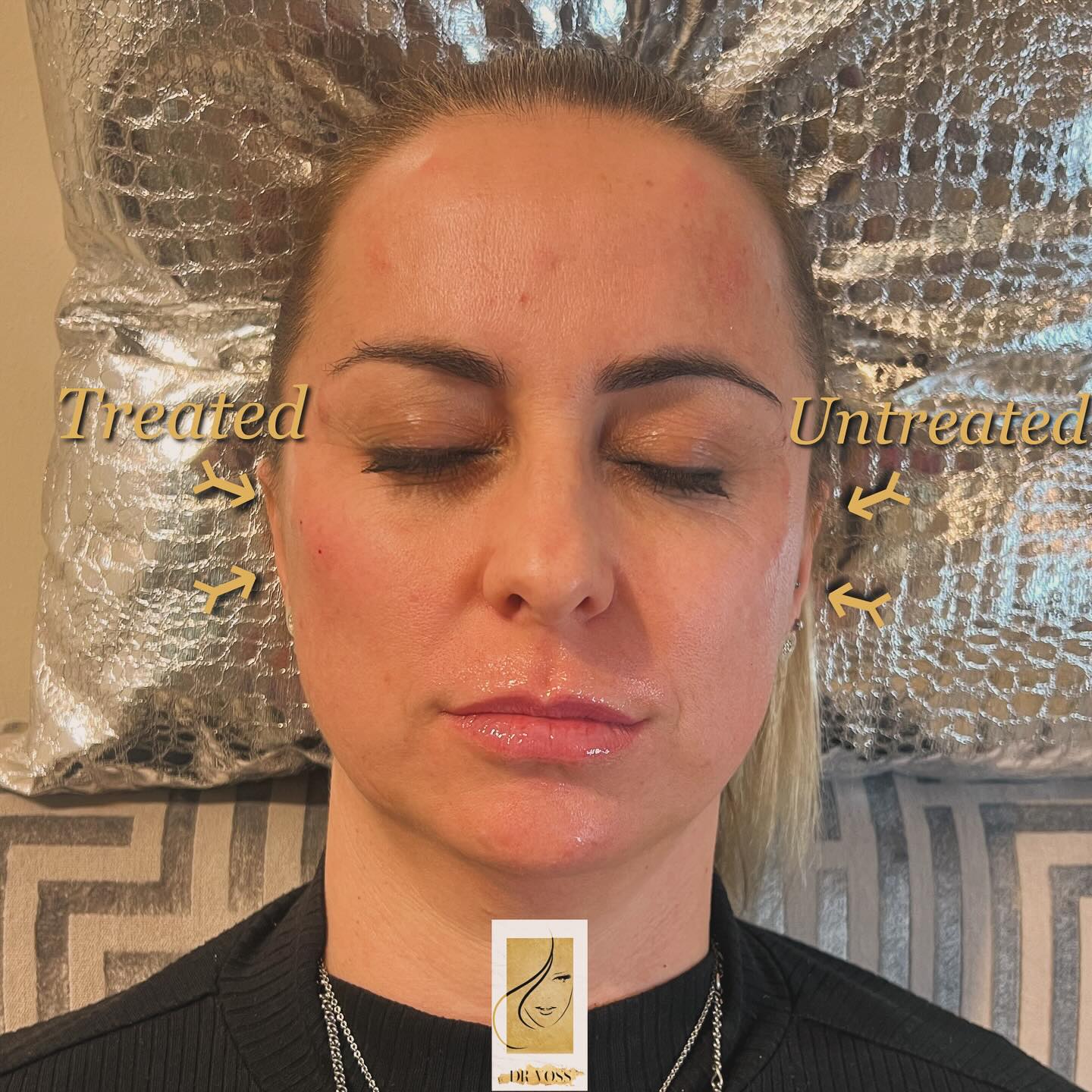 Dr.Voss - 📍”Super Model/ Lateral High” Cheek augmentation...