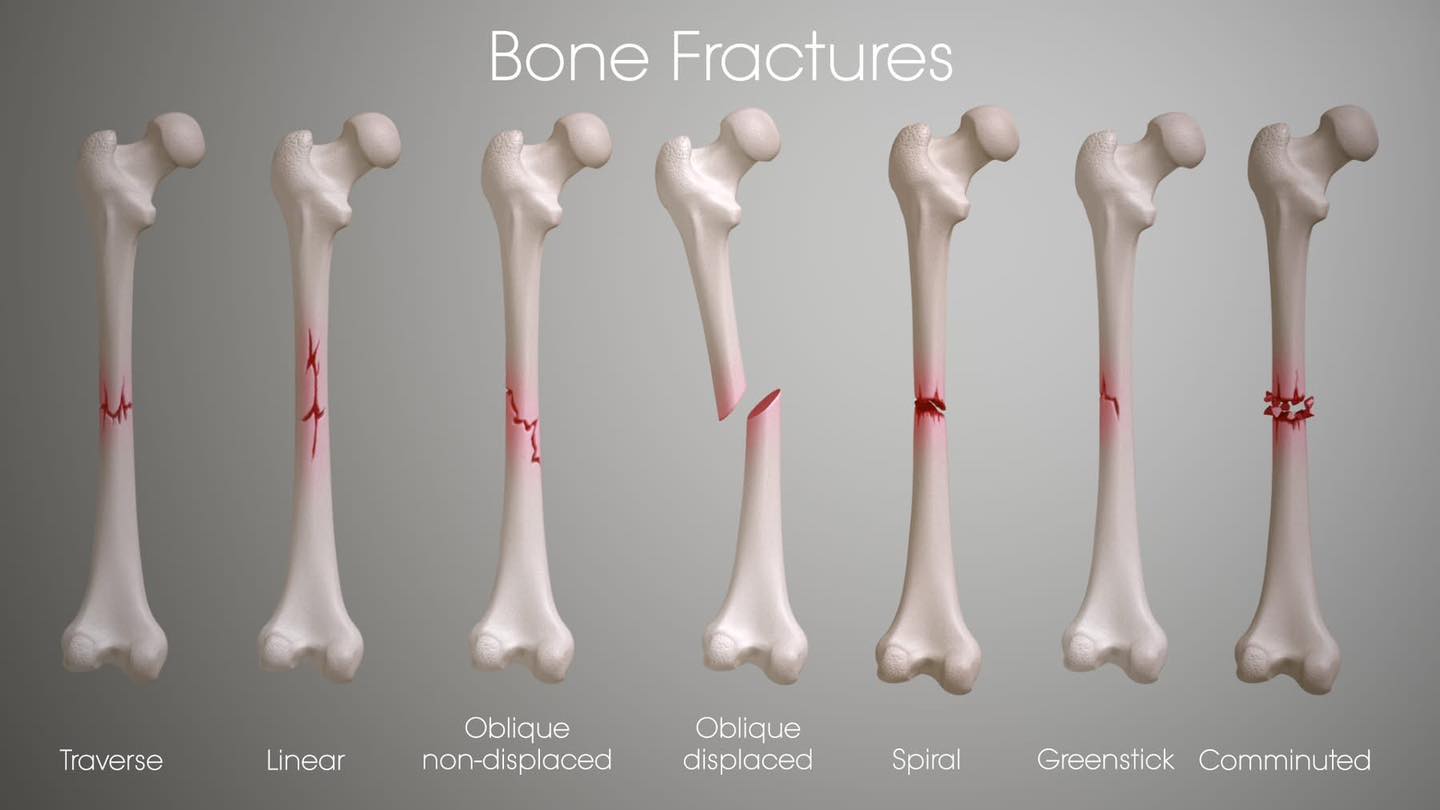 Legacy - Common Types of Bone Fractures 🦴 Transverse Fracture Break ...