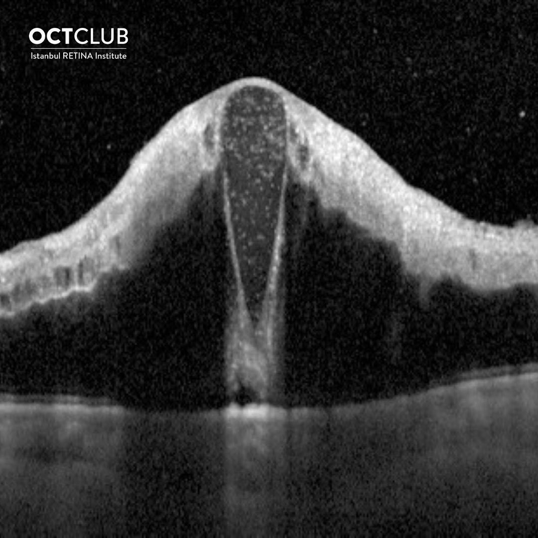 OCT Club