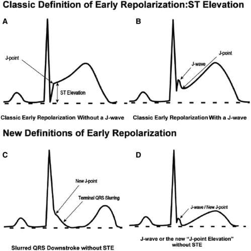 🫀 The J Wave (Osborn Wave) in ECG A deflection at the QRS-ST