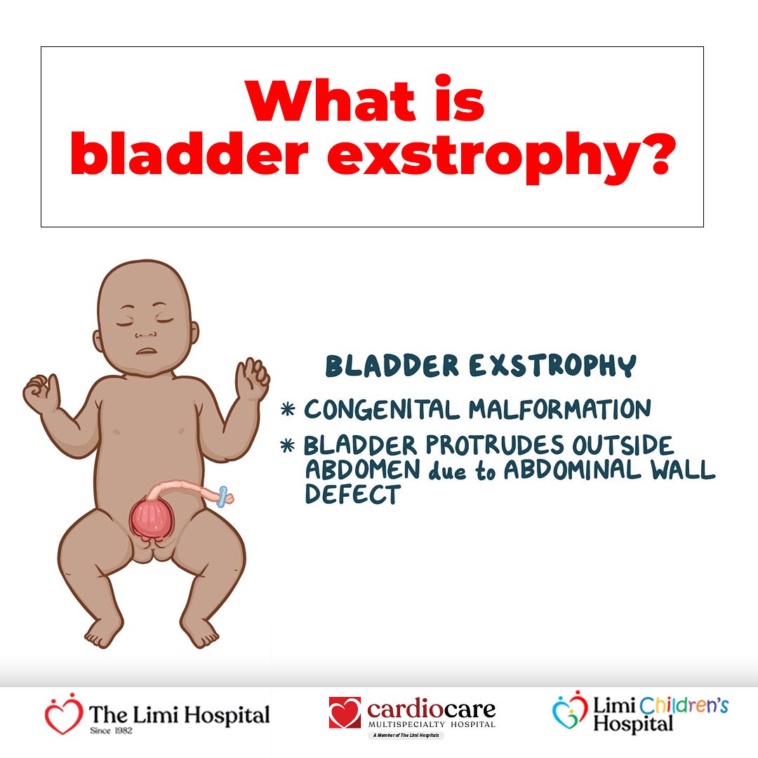 What is Bladder Exstrophy?... - The Limi Children's Hospital