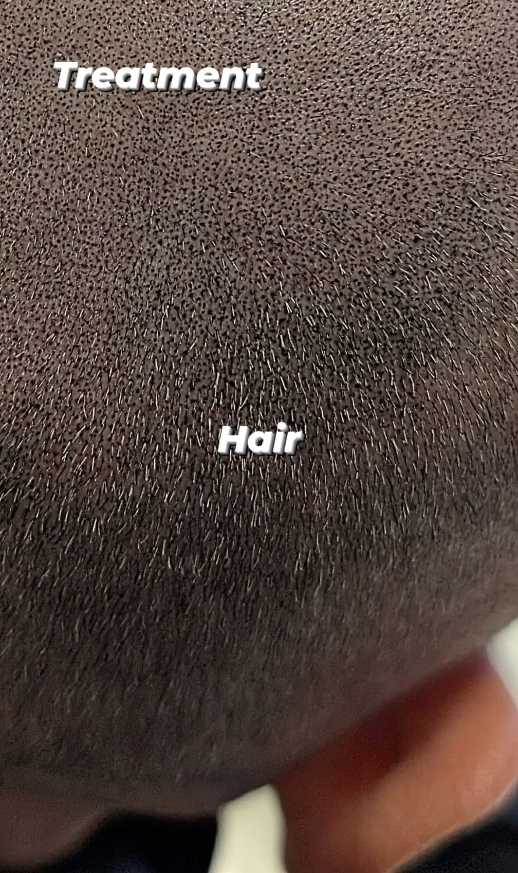 Octoink Scalp Micropigmentation