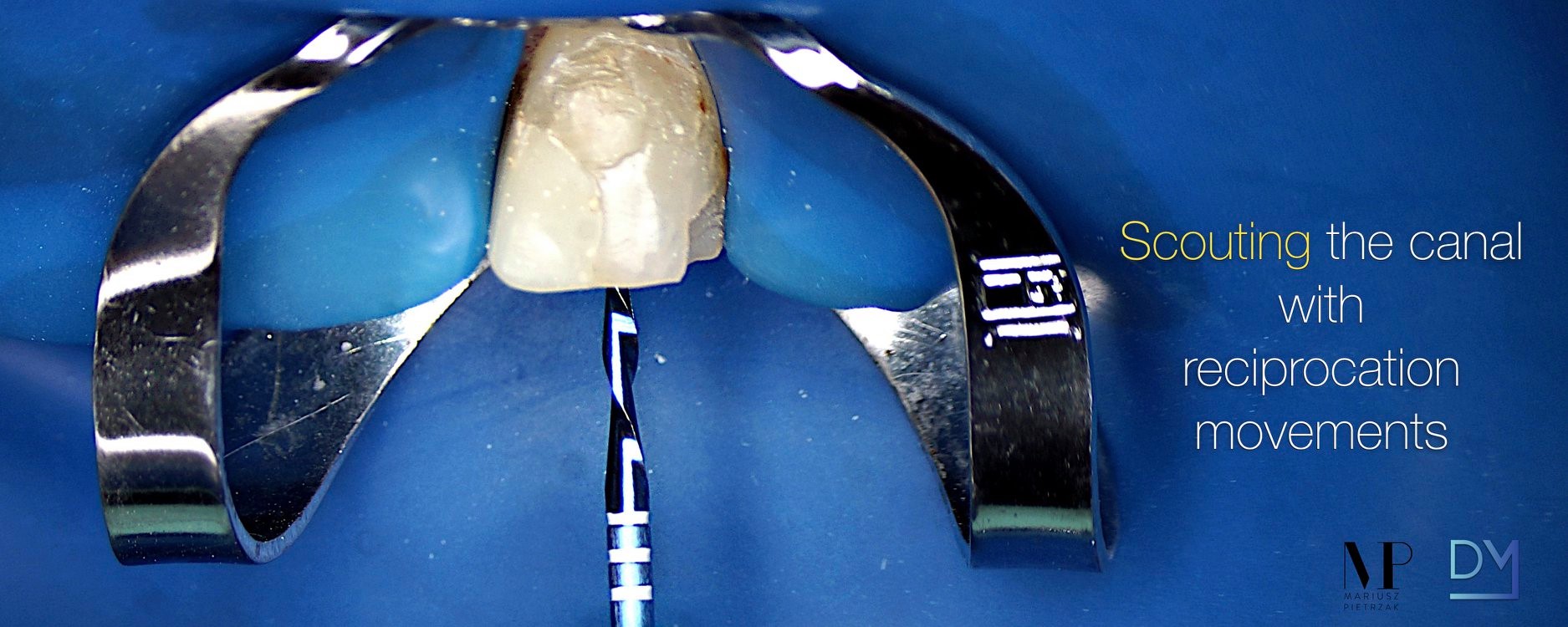 Nothing fancy. Upper symptomatic incisor. Sometimes it is great to 