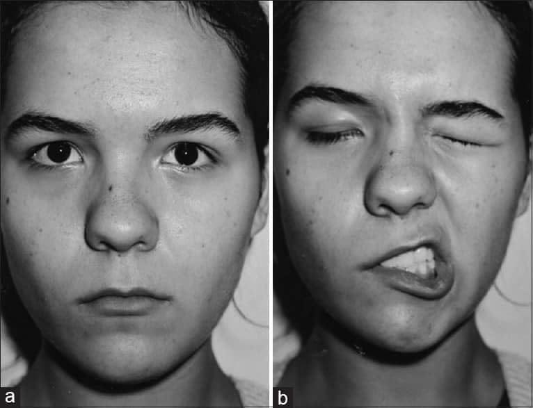 The Dental - “Facial nerve paralysis after dental procedure” Peripheral ...