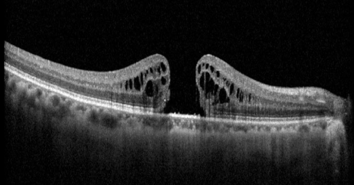 Retina - RCTX is excited to announce that an original study and article ...