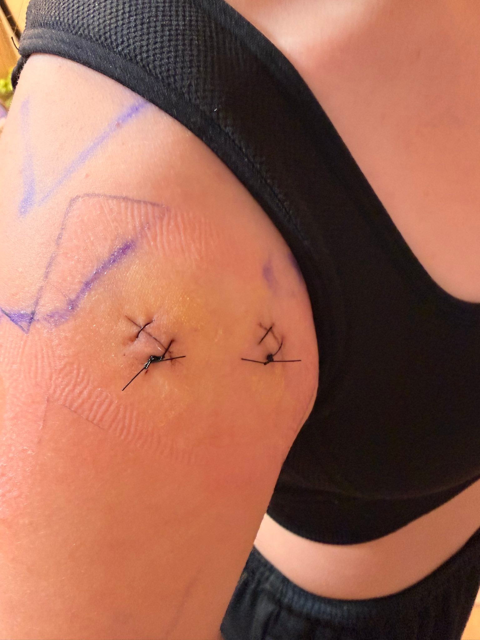bpc 157 labrum tear reddit What helps with surgery recovery and arm pain? cellular health Program:12 Week Regenerative Program BPC-157 Peptide Therapy Burbank