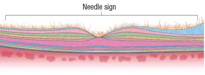 Needle sign: ️The... - Ophthalmology-Notes And Synopses | Facebook