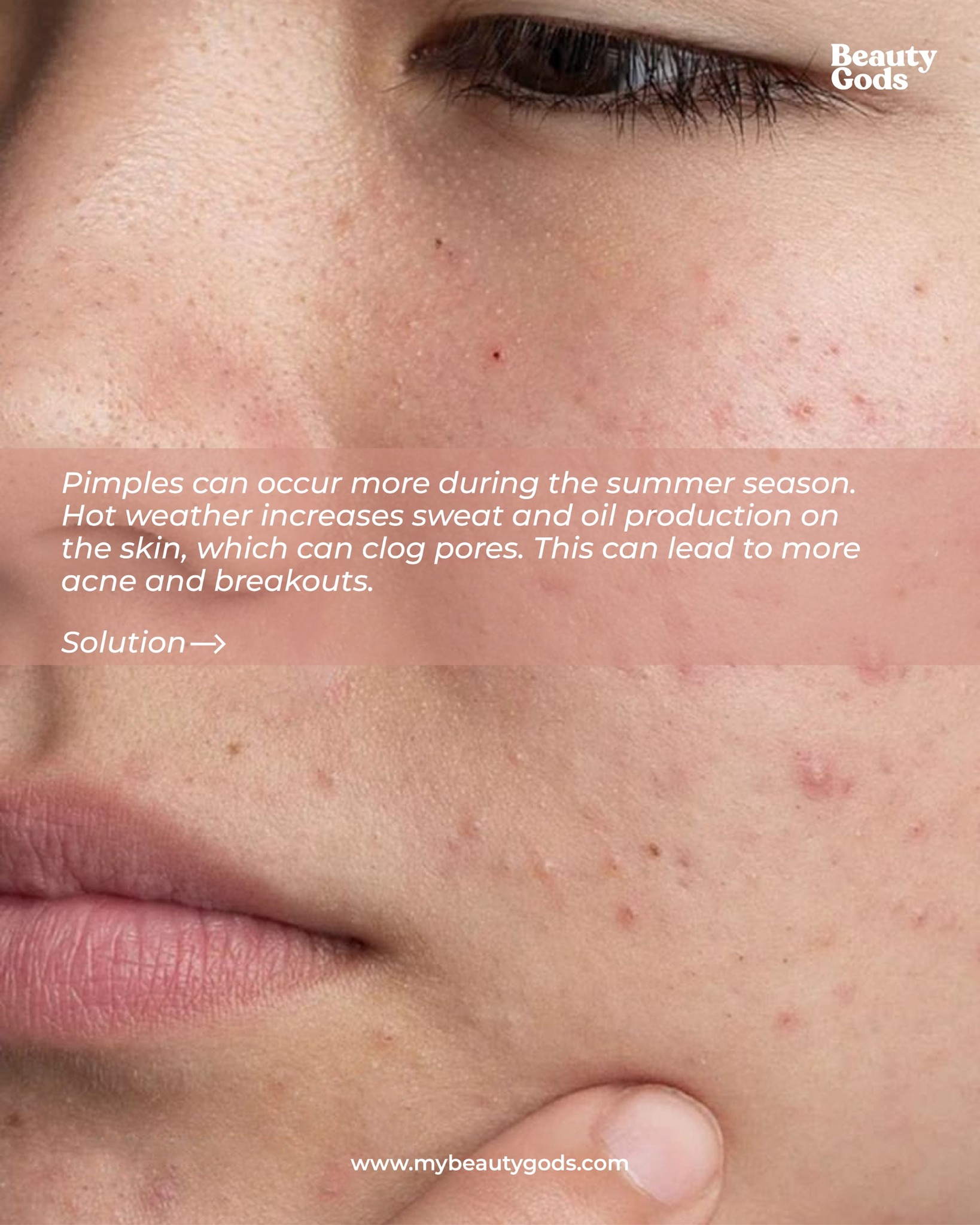 can glutathione remove pimples Summer heat increase and acne. ☀️ Keep your skin clean and balanced with Beauty Gods Face Wash & Face Cream. Hot weather increases sweat and oil production, which can clog Peptide Therapy for Fairfield, تونر نياسيناميد Sold per Bottle:30 mL