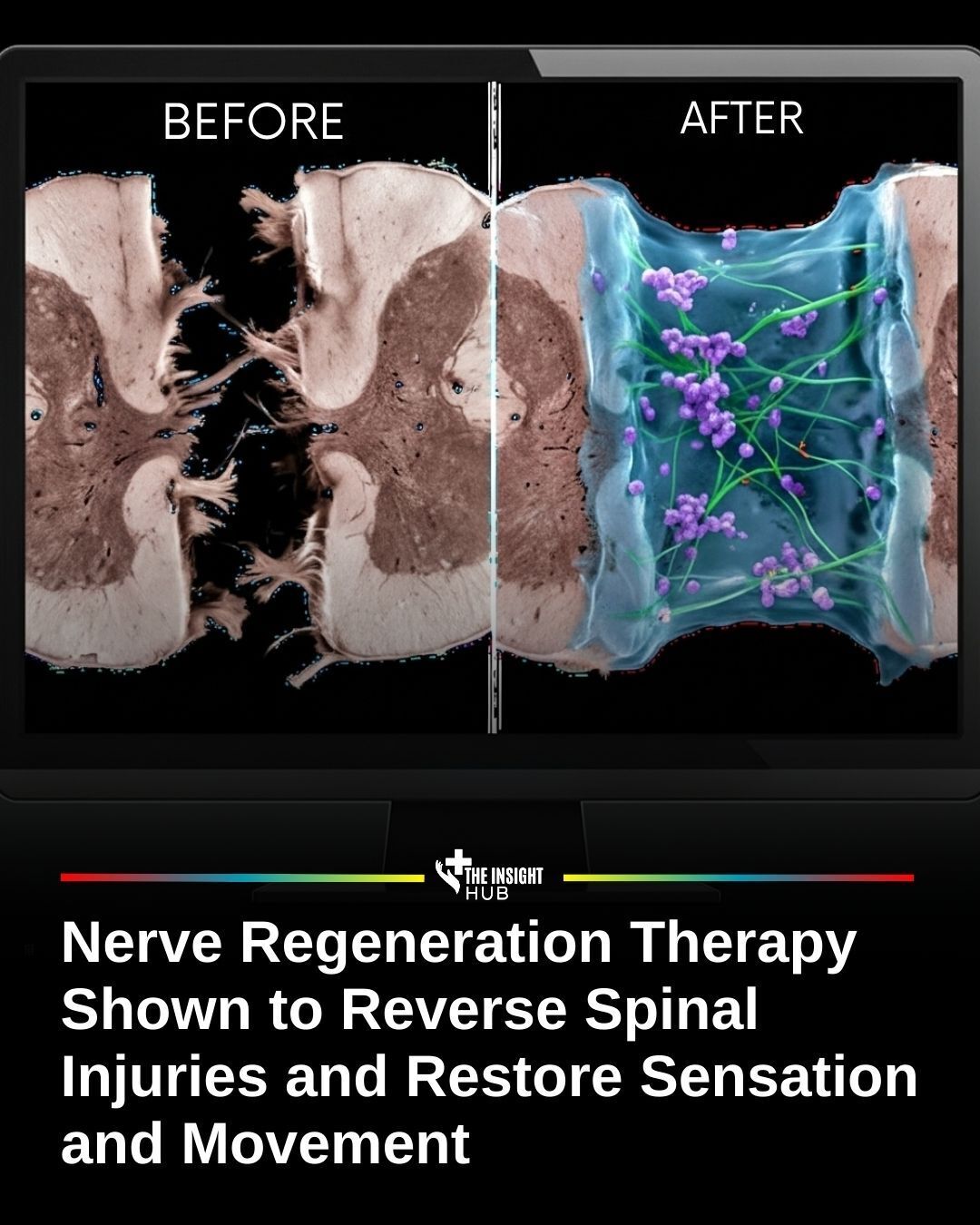 DJ Sharpnel – S.E.X. -Sound Of EXtreme- Did bullet removal improve spinal cord injury recovery?