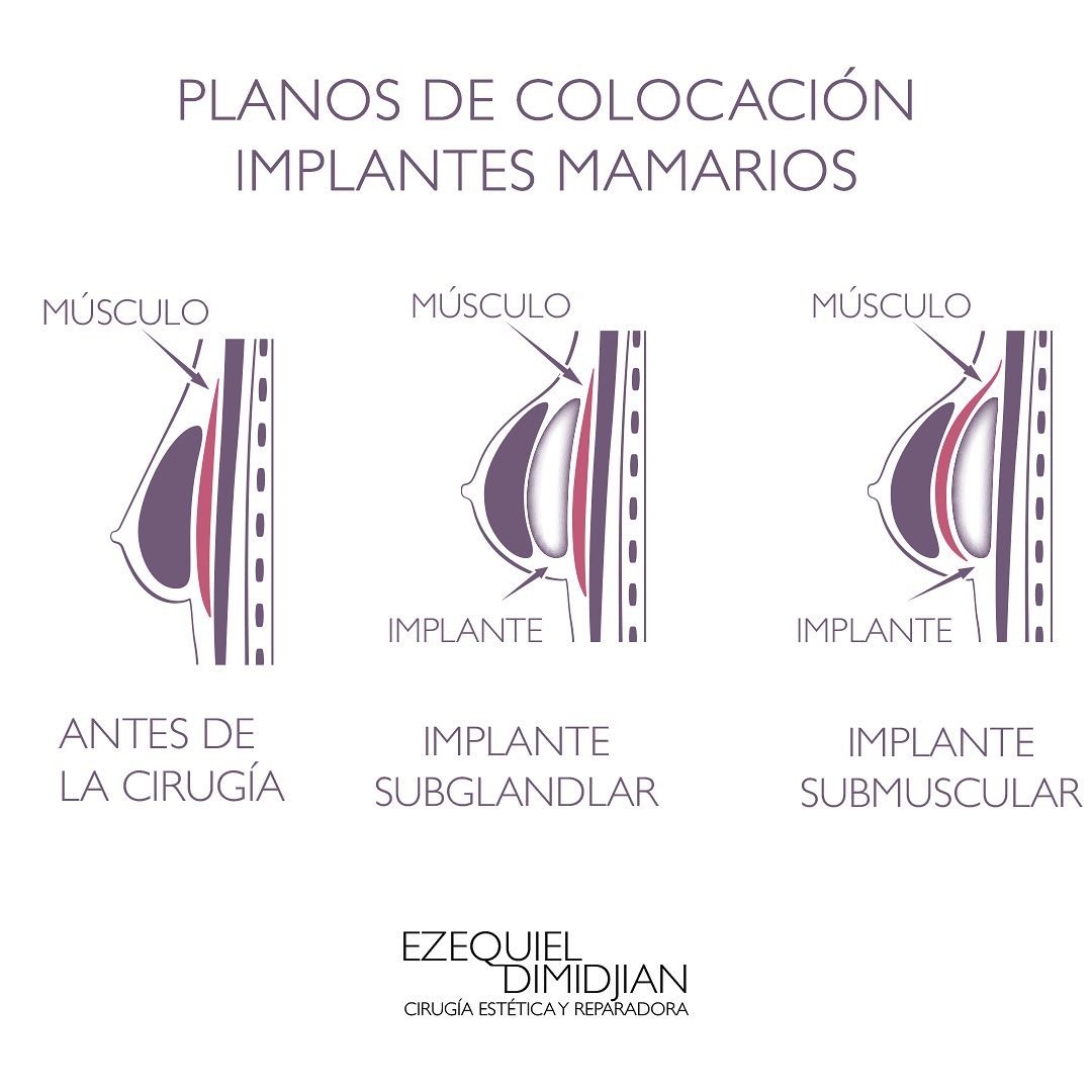 Dr Dimidjian - Planos de colocación en una cirugía de...