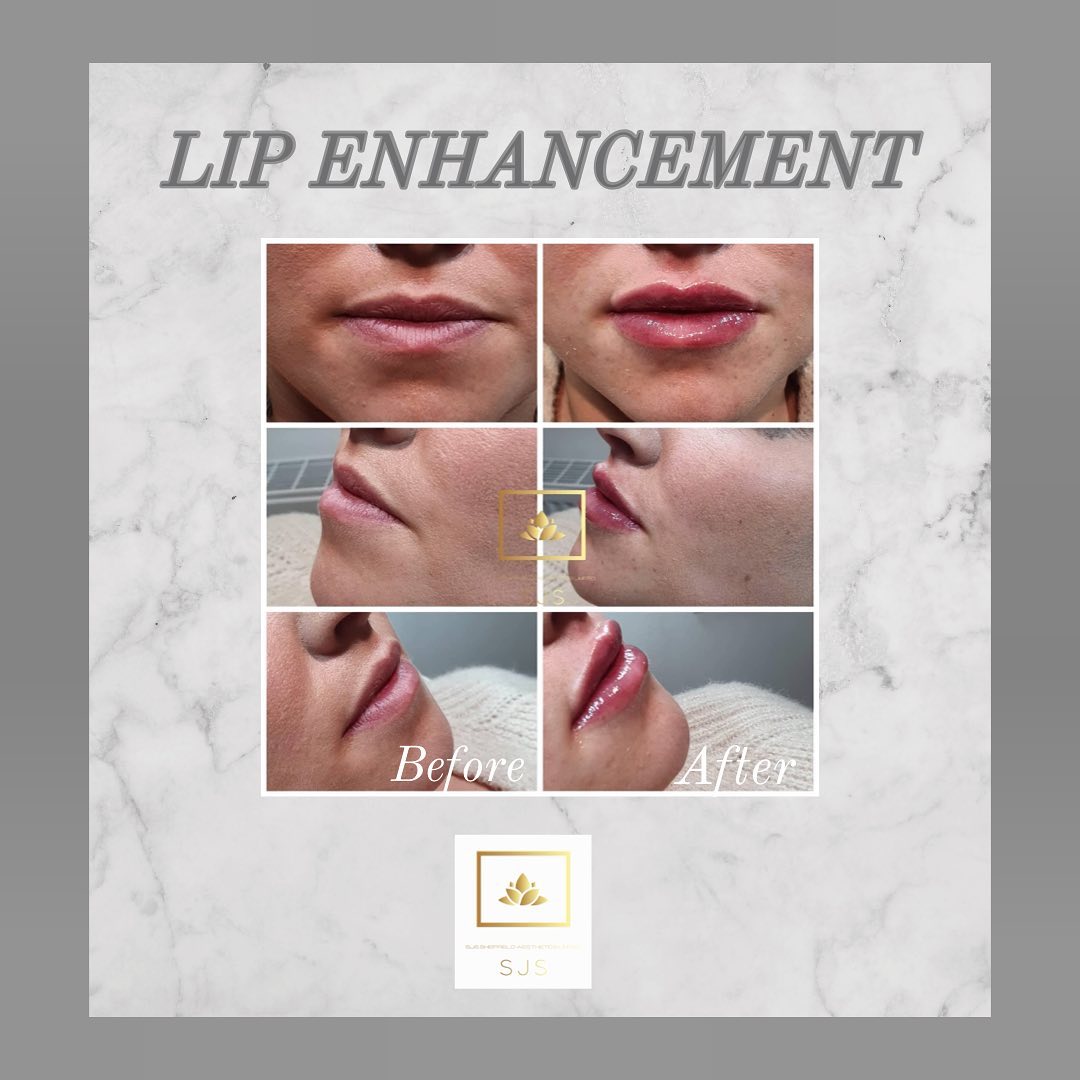 An amazing lip... - SJS Sheffield Aesthetics Limited