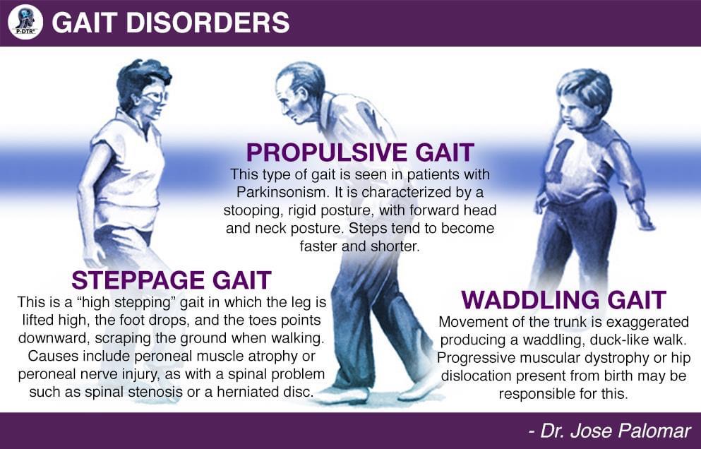PDTR - Understanding gait disorders is key in diagnosing neurological ...