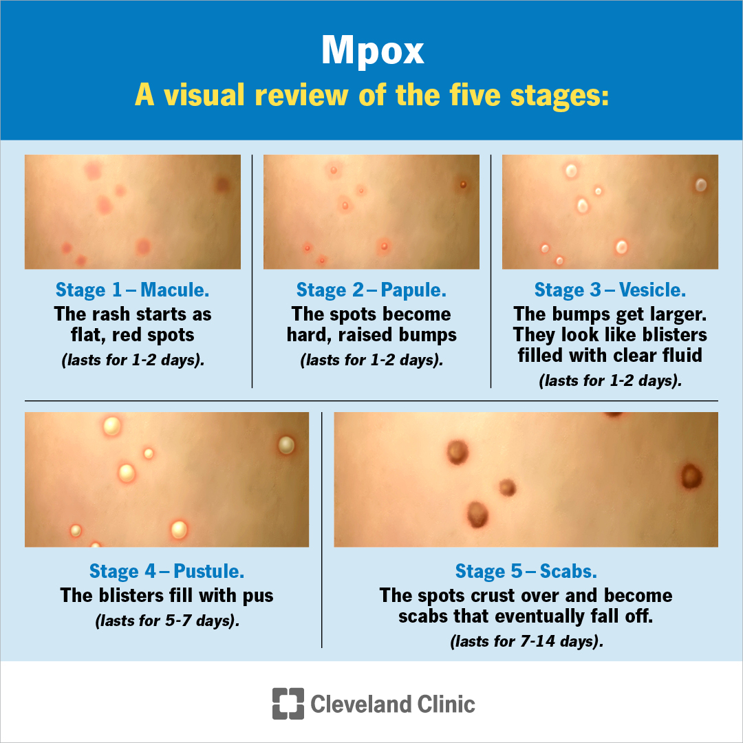 Cleveland - Mpox (previously known as monkeypox) is a rare disease ...