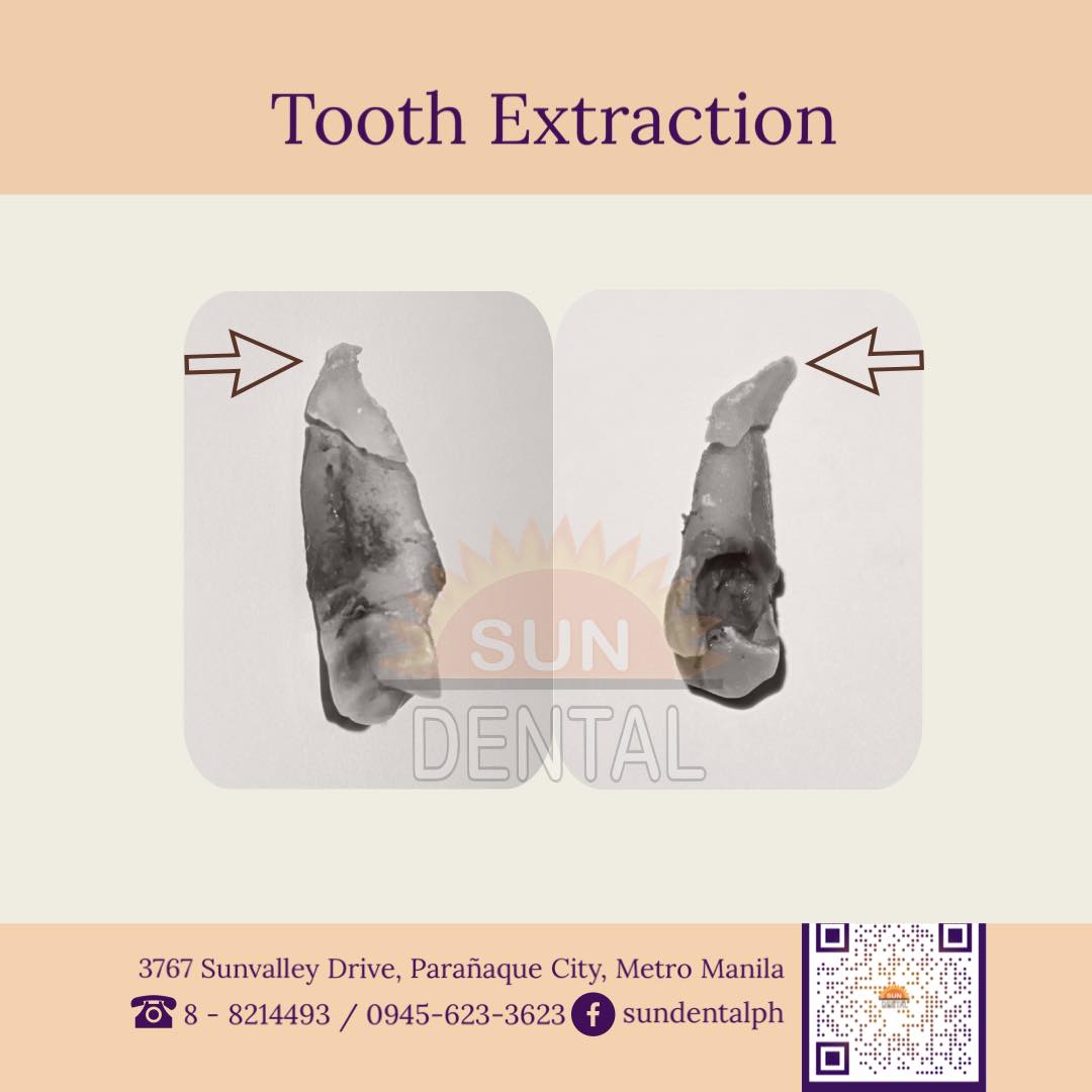 Sun Dental - Never underestimate a tooth! Tooth... | Facebook