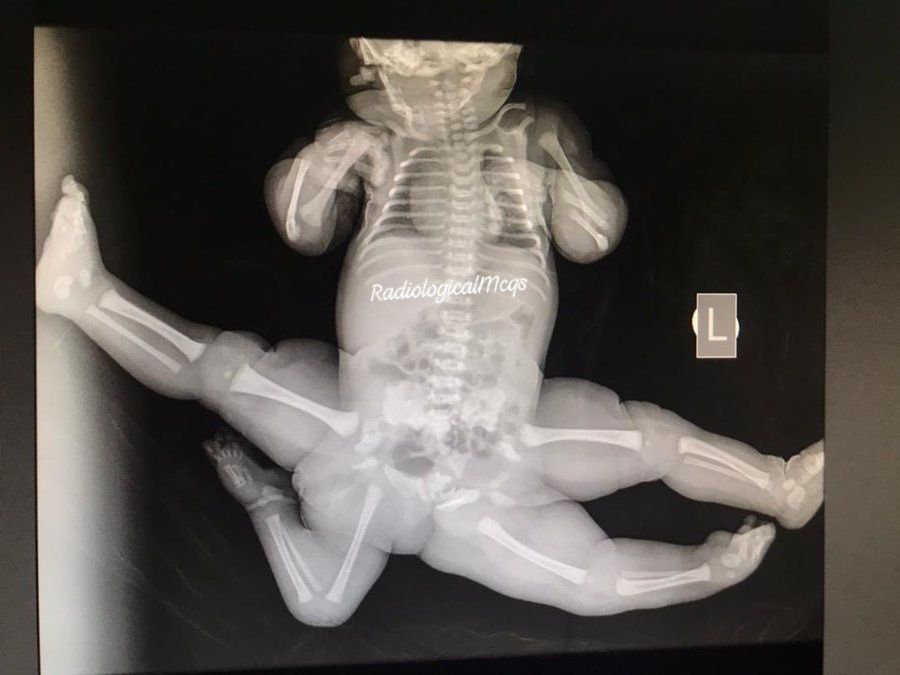 Radiological - The X-ray of the baby.Look how complex the condition is ...