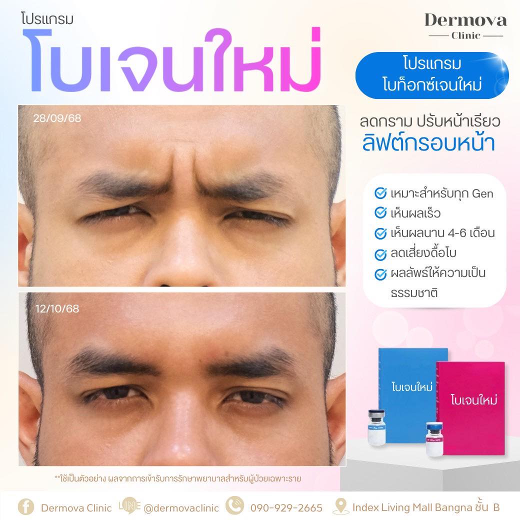 Dermova - 🩵 โบเจนใหม่ ผิวตึงอ่อนเยาว์ 🩵 ผิวแน่น ตึงกระชับ เรียบเนียน ...