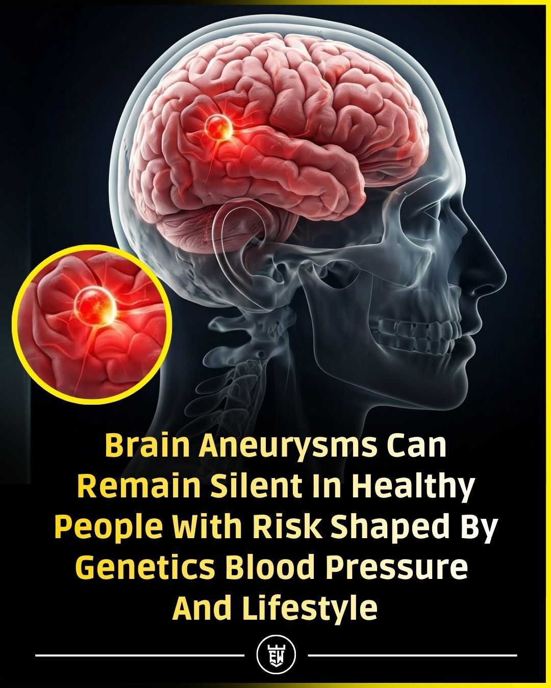 Explaining - Brain aneurysms can exist quietly for years without ...