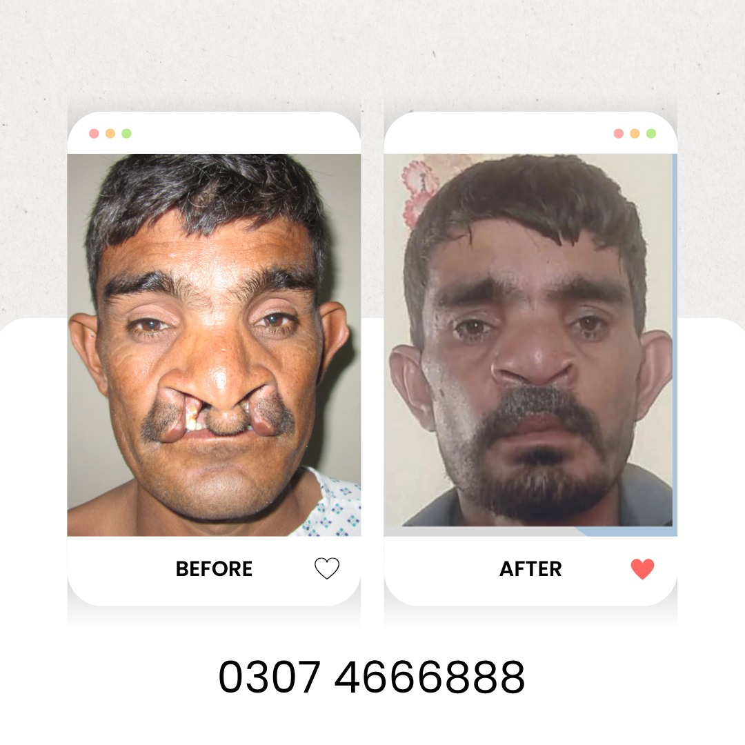 Smile - Free Cleft Lip and Cleft Palate Surgery In Lahore By Dr Irfan ...