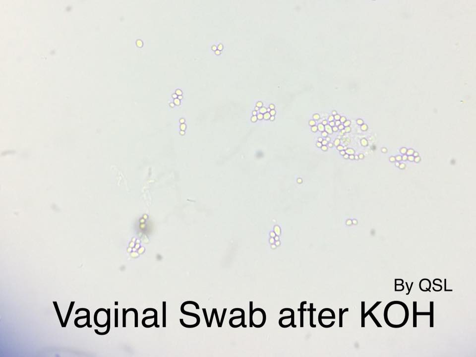 High Vaginal Swab ( HVS ): #One... - مختبر قلقيلية التخصصي