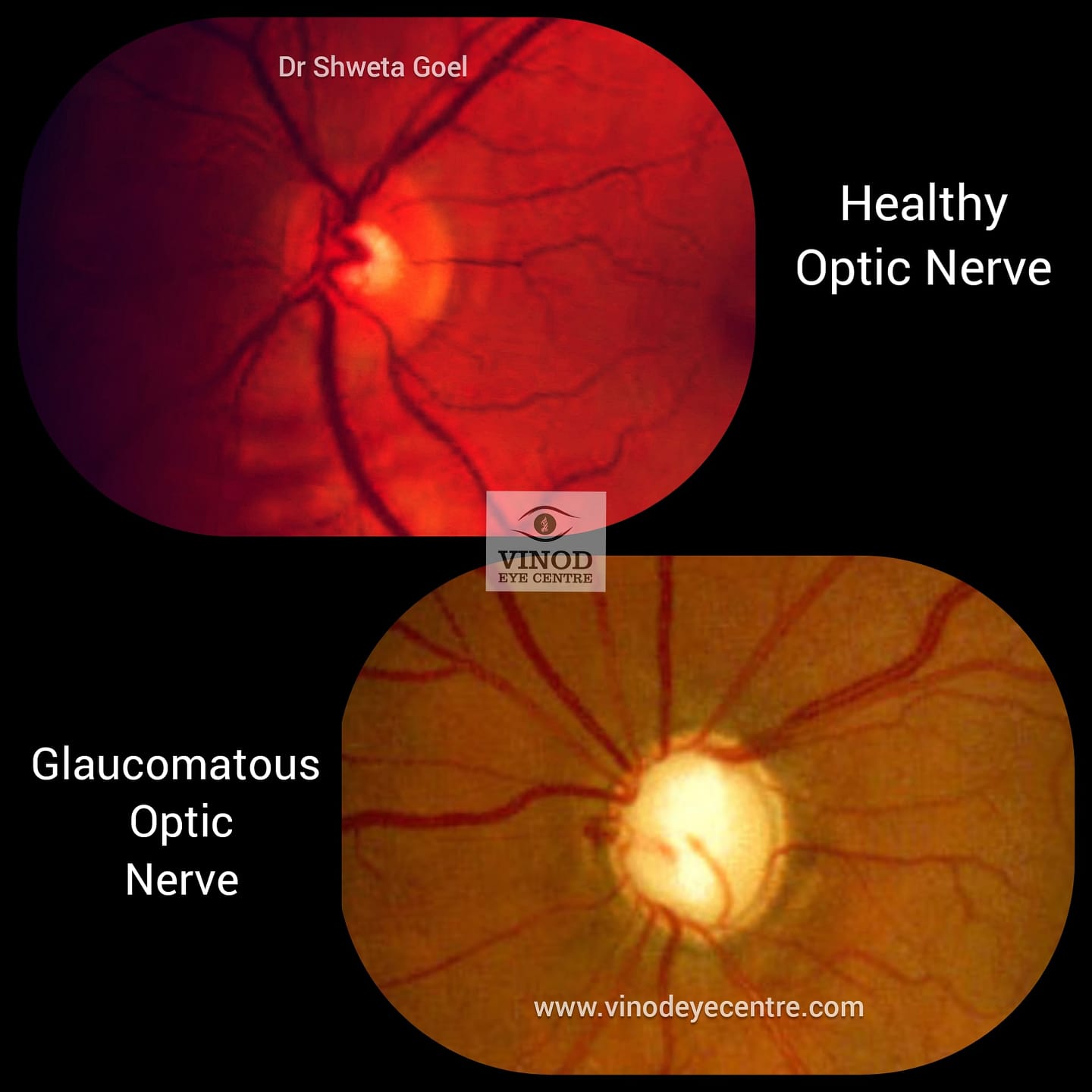 Siimplyy EYE - Spot the Cup-to-Disc Ratio (CDR) of both... | Facebook