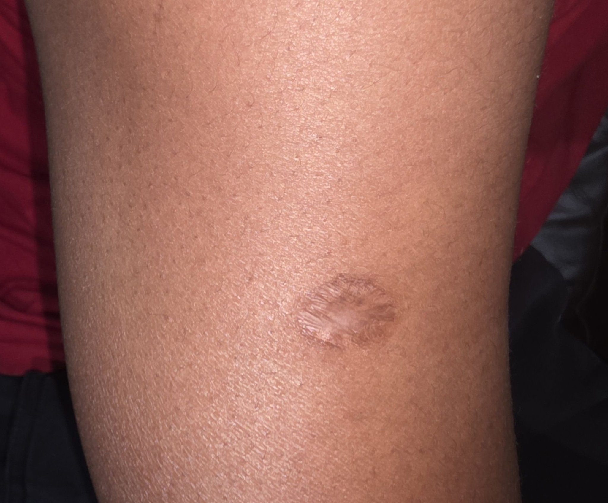 Dr. S. Mangombe - This one is a BCG injection scar. Haisi... | Facebook