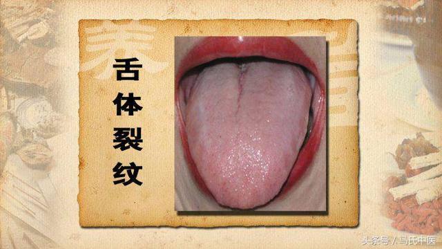 德義堂 - 舌上出現裂紋，中醫病理病機分析 馬氏中醫 舌裂 [概念] 舌上出現裂紋，其形狀有橫形、縱形、人字形、川字形、井字形等，均稱為舌裂 ...