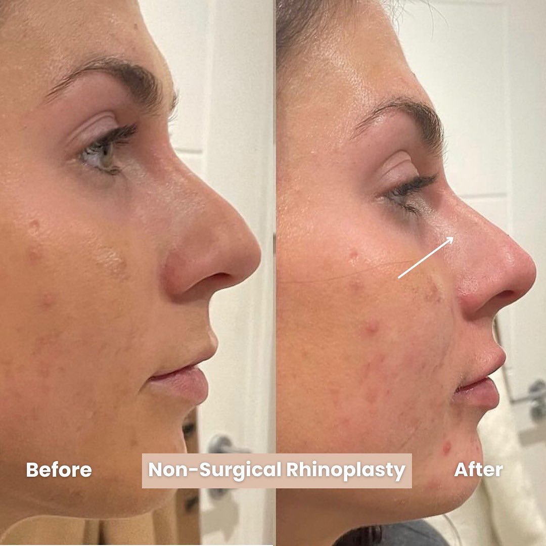 💥 Non-Surgical Rhinoplasty by Dr Rosh... - Cavendish Clinic