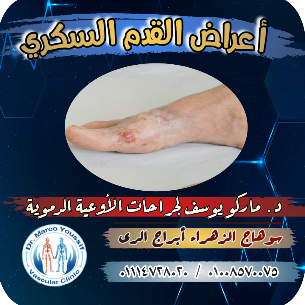 ♦️ تأثير مرض السكر على القدمين 👇👇 1️⃣ فقدان الإحساس 👇 الإحساس بالألم ...