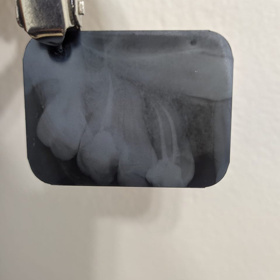CANAIS RADICULARES CURVOS: . A... - DentBelle Odontologia | Facebook